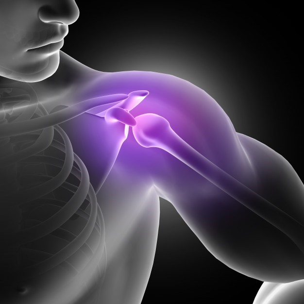 3D figure of an inflamed shoulder