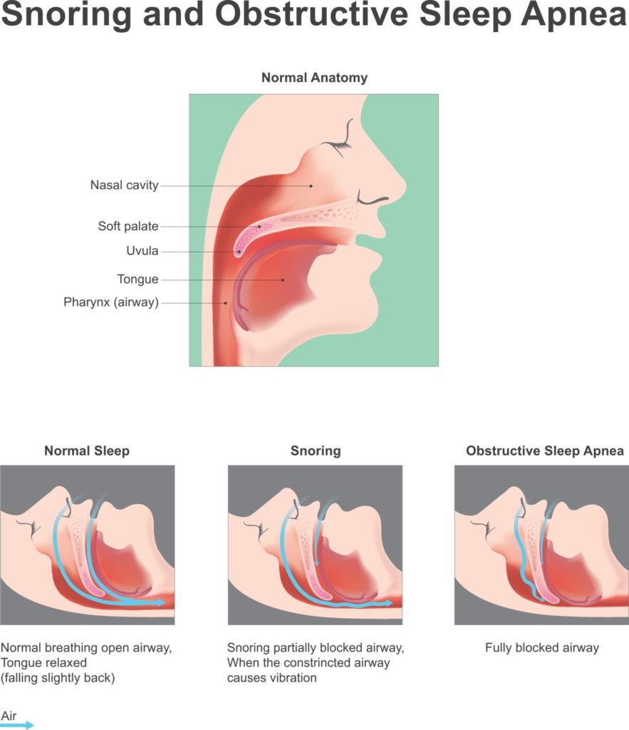 An illustration depicting normal sleep, snoring, and obstructive apnea.