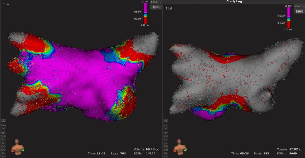 Ablation showing rhythmia in the left atrium