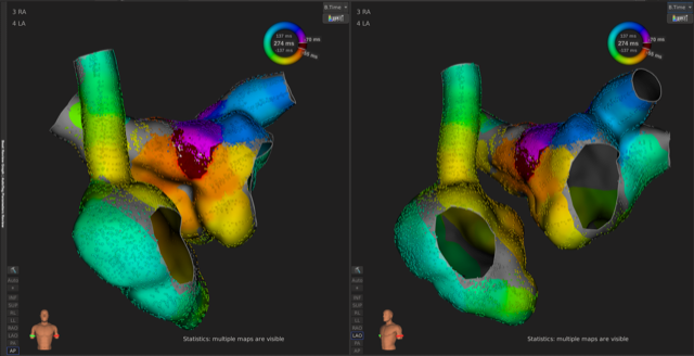 Ablation procedure to treat rhythmia in the left atrium.