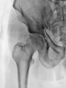 x-ray scan of the hip joint