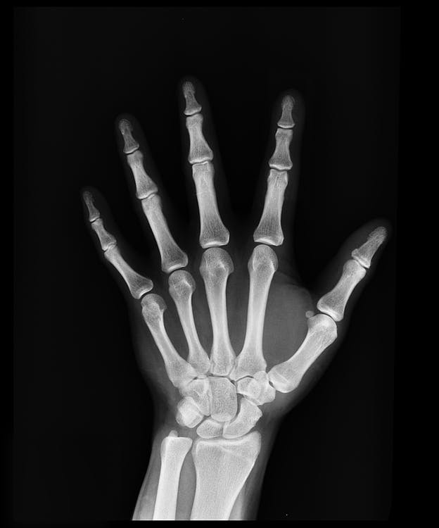 An X-ray of a hand.