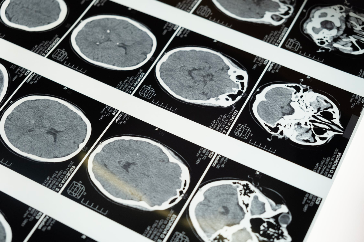 A sheet showing MRI scans of a patient’s brain.