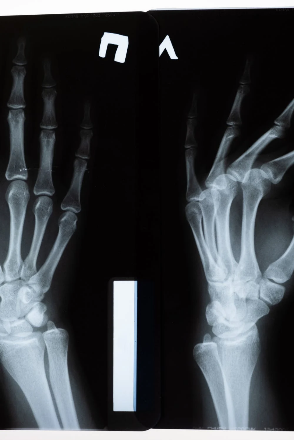 X-ray image of a person’s hands. 