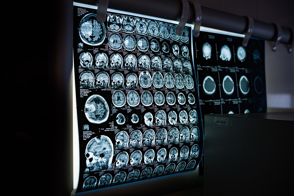 Brain scans on a screen