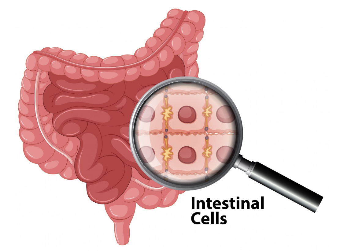 An anatomical illustration showing inflamed intestinal cells, representing inflammatory bowel disease.
